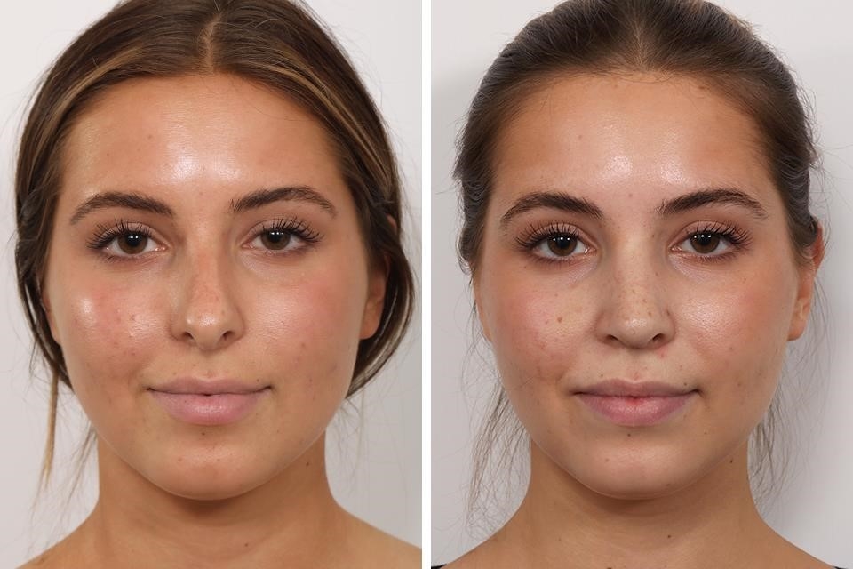 closed vs open rhinoplasty