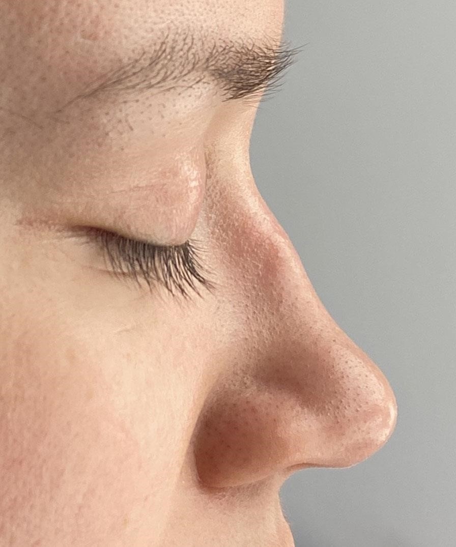 closed vs open rhinoplasty